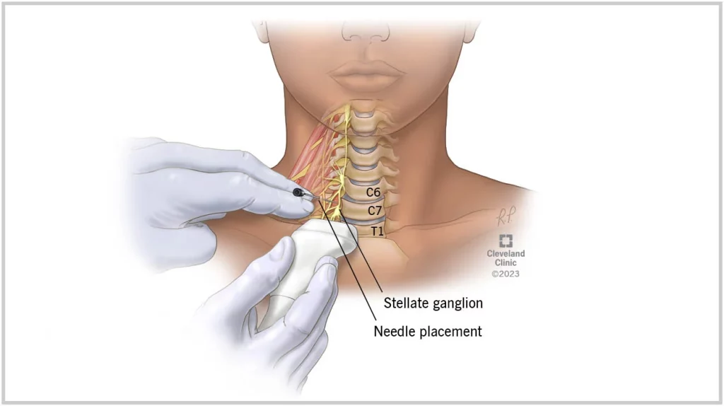 Stellate Ganglion Block long covid